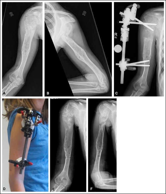 Radiographs and clinical photograph of humeral lengthening and procurvatum correction with a monolateral rail in Ollier disease