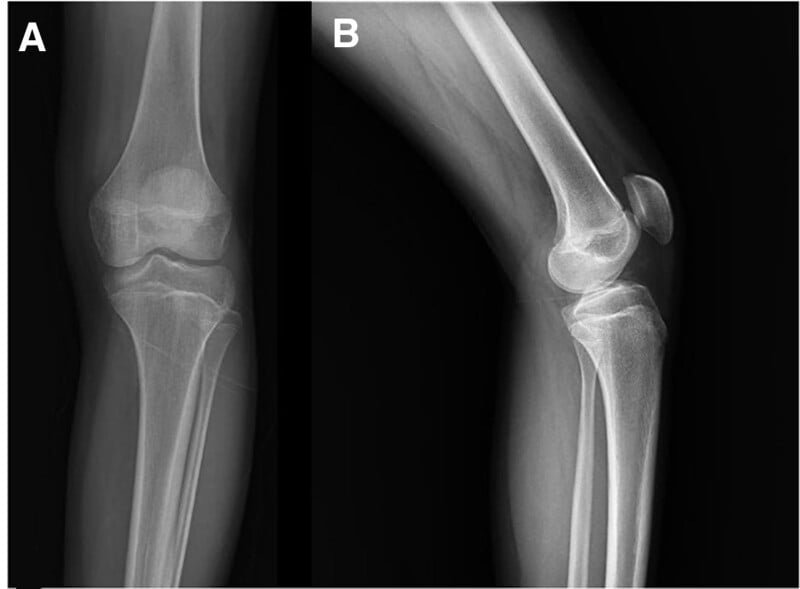AP and lateral knee radiographs showing a metaphyseal cartilage column that has ossified into normal bone by skeletal maturity