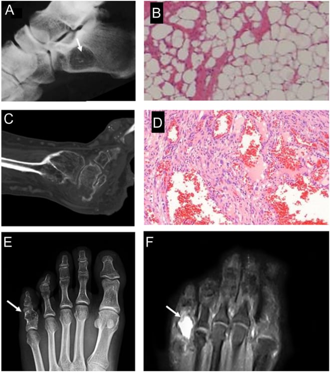 CT of the foot in Maffucci syndrome with histology showing haemangiomas alongside hyaline cartilage matrix, and an intraosseous lipoma for comparison