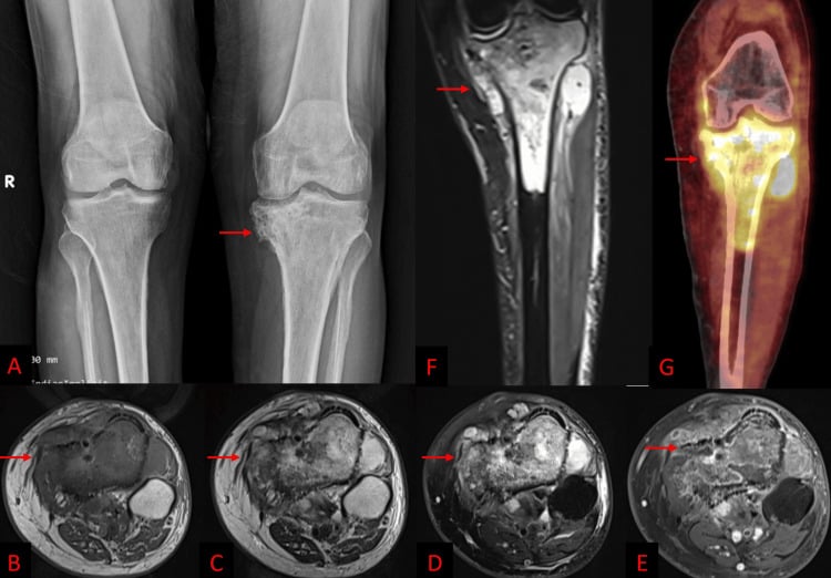 Radiograph and multiparametric MRI of a proximal tibial lesion with irregular margins, enhancement and extraosseous soft-tissue extension