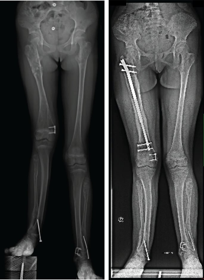 Preoperative and one-year radiographs showing clearance of enchondromas within the reamed canal after intramedullary nail lengthening