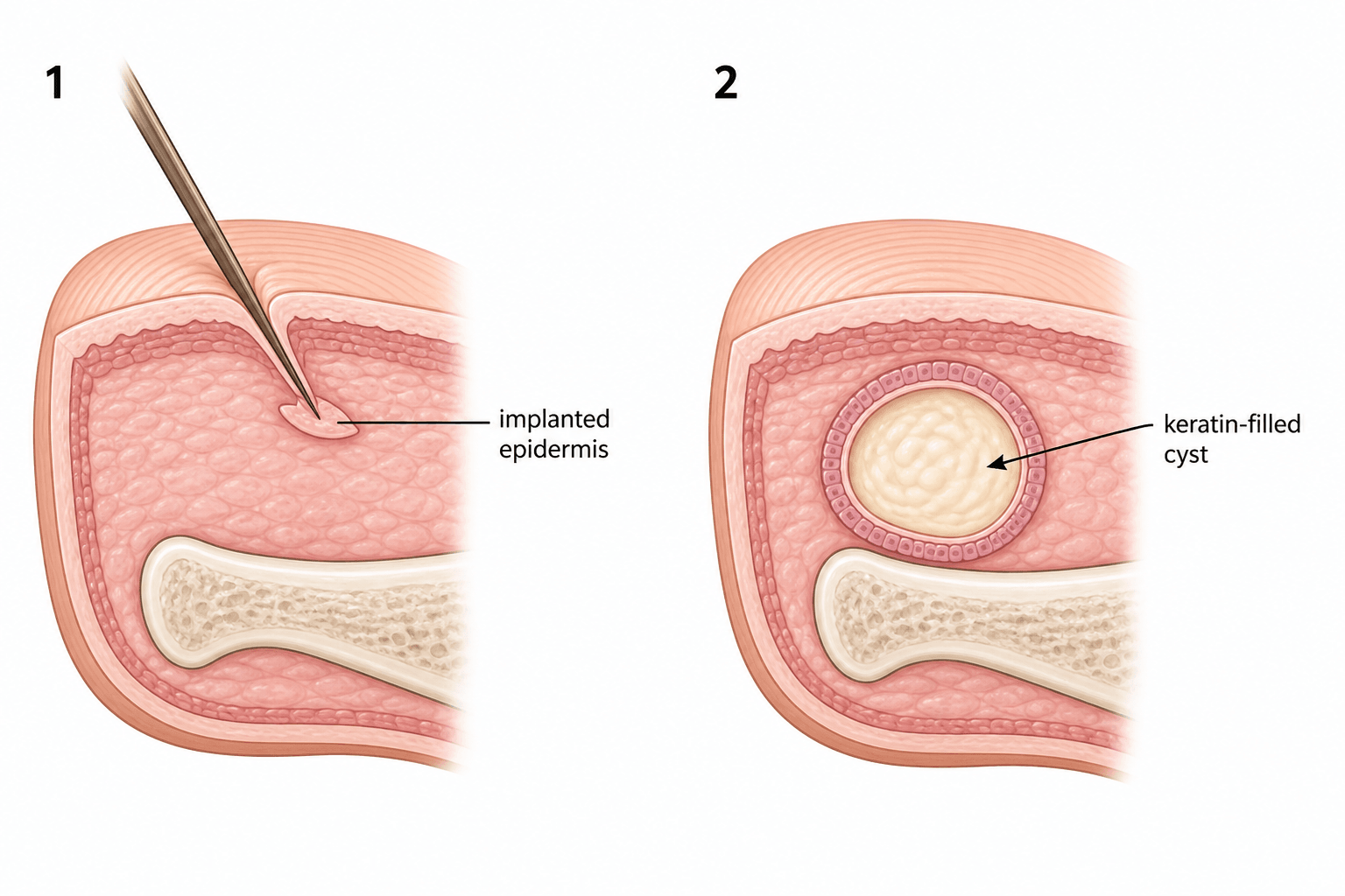Two-panel diagram showing implantation of epidermis into the finger by a sharp object and the resulting keratin-filled cyst over the distal phalanx