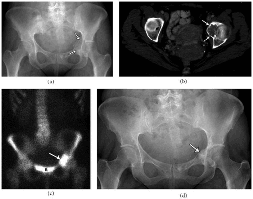 Radiograph and axial CT showing a lytic acetabular lesion containing chondroid matrix.