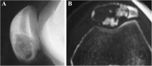 Radiograph and further imaging of a patellar lesion with lobulated sclerotic margins and internal calcification.