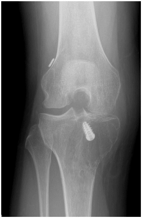 AP knee radiograph with an osteolytic lesion in the medial tibial plateau extending to the epiphysis.
