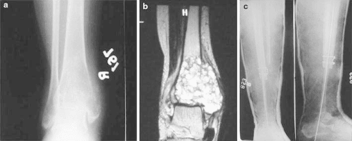 Three-panel figure: radiograph of a lytic epiphyseal lesion, corresponding MRI, and post-operative radiographs.