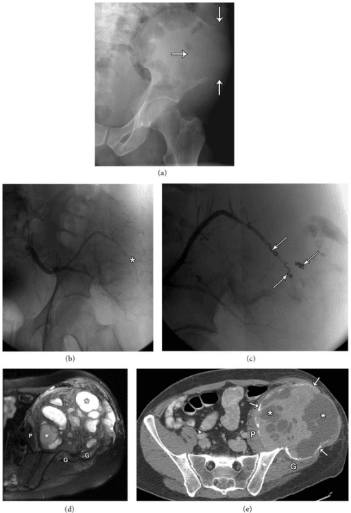 Pelvic radiograph showing a large expansile lytic destructive lesion of the iliac wing.
