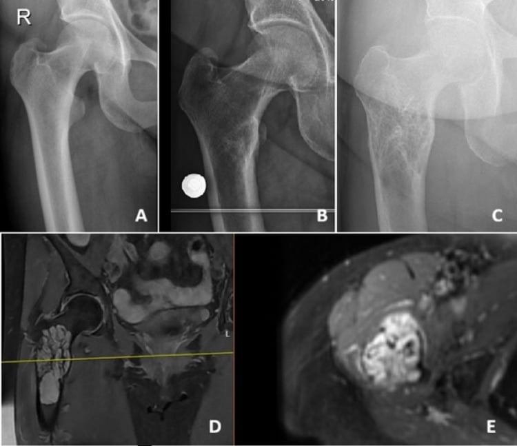 Serial radiographs and MRI showing progressive growth of an epithelioid haemangioma in the proximal femur