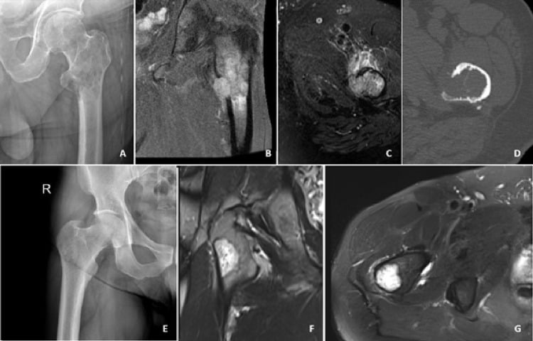 Radiographs, CT and MRI comparing epithelioid haemangioma and epithelioid haemangioendothelioma of bone