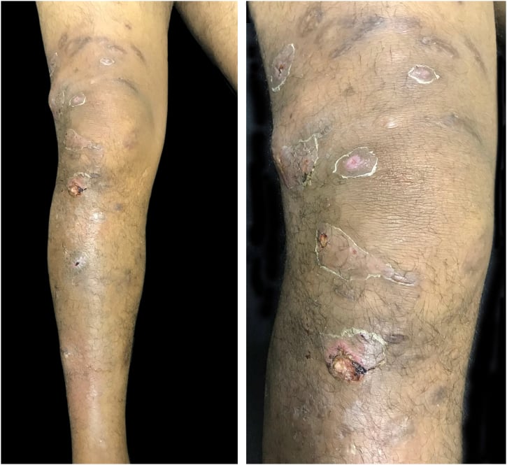 Clinical photographs showing multiple erythematous-violaceous distal-type epithelioid sarcoma nodules of the lower limb, some ulcerated.