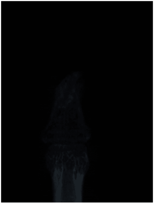 Single plain radiograph of a finger showing erosion and thinning of the distal phalanx beneath an epithelioid sarcoma