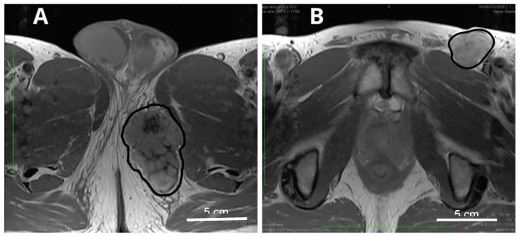 Cross-sectional imaging of proximal-type perineal epithelioid sarcoma with regional lymph-node metastases.