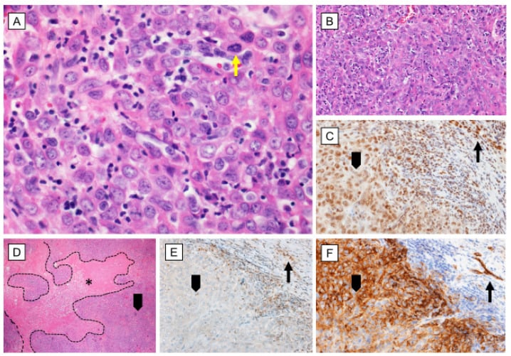 H and E micrographs showing sheets of epithelioid sarcoma cells around marked geographic central necrosis.