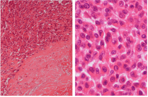 Two-panel H and E histology of epithelioid sarcoma of the forearm showing sheets of tumour cells with necrosis and high-power atypical epithelioid cells