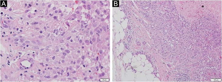 H and E histology showing epithelioid cells with mild atypia in a granuloma-like arrangement, dermal and subcutaneous infiltration and focal necrosis.