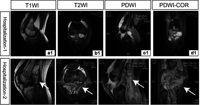 Serial multiplanar knee MRI showing intra-articular epithelioid sarcoma initially obscured by joint fluid and later visible as nodular synovial disease.