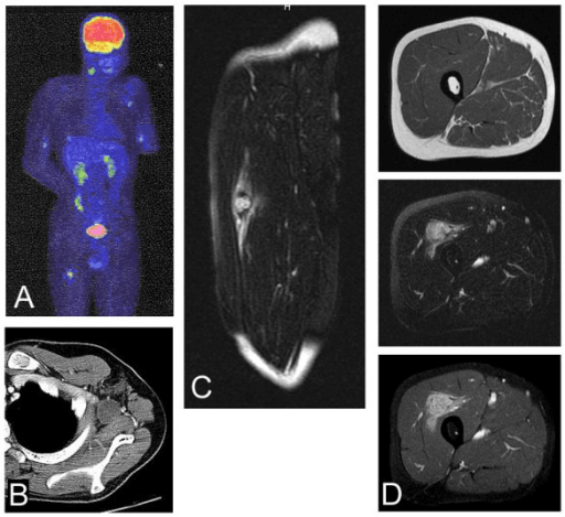 Multi-panel staging imaging of metastatic epithelioid sarcoma with whole-body FDG-PET, fused PET-CT of the neck, and MRI of a limb soft tissue mass