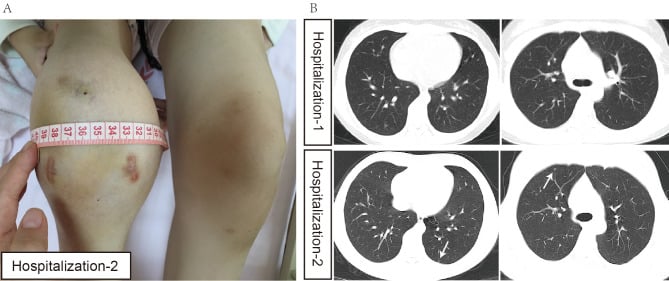 Clinical swelling of the knee with chest CT images showing multiple small pulmonary nodules from epithelioid sarcoma.