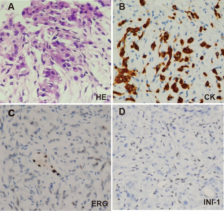 Epithelioid sarcoma histology with cytokeratin positivity and loss of INI1, while ERG is negative.