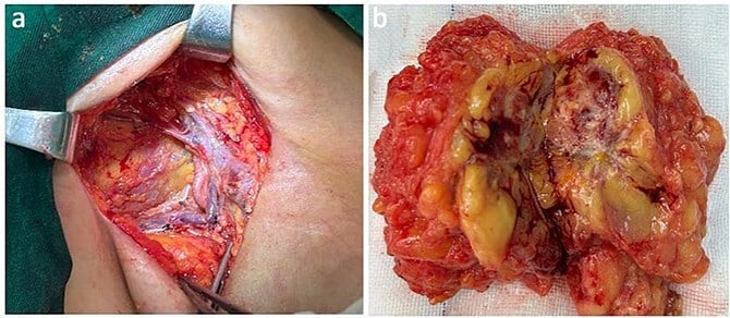 Operative view and resection specimen of ill-defined multinodular metastatic proximal-type epithelioid sarcoma in the axillary musculature.