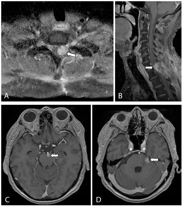 Contrast-enhanced MRI showing recurrent cervical spinal epithelioid sarcoma involving the cord and neural foramen with new enhancing intracranial metastases.