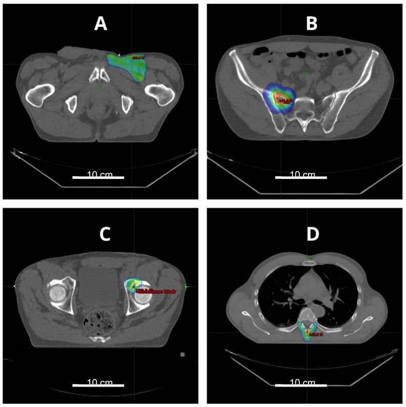 Radiotherapy planning images showing adjuvant treatment of an epithelioid sarcoma primary site and stereotactic body radiotherapy for oligometastases.
