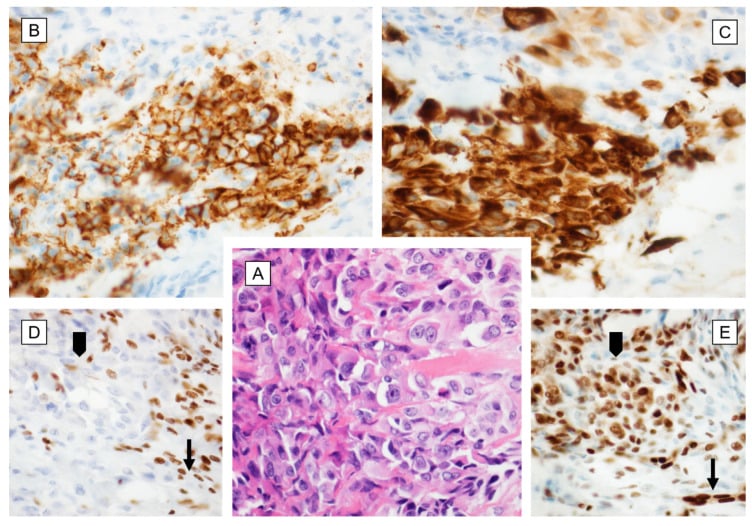 Epithelioid sarcoma micrographs showing epithelioid morphology, CD34 and cytokeratin positivity and loss of nuclear INI1.