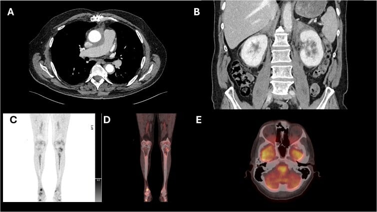 CT and PET imaging of Erdheim-Chester disease showing periaortic thickening, the hairy kidney sign, symmetric long-bone uptake, and orbital involvement