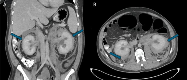 Coronal CT of abdomen demonstrating hairy kidney sign in Erdheim-Chester disease