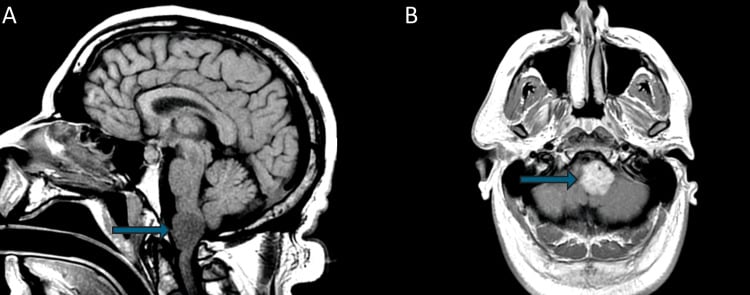Sagittal T1 MRI of craniocervical junction lesion in Erdheim-Chester disease