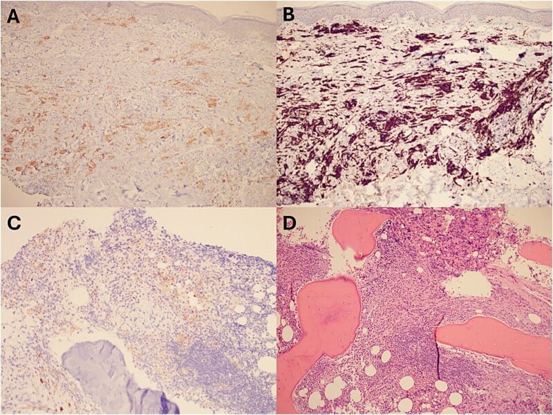 Histopathology of Erdheim-Chester disease showing H&E and BRAF V600E immunostaining of skin and bone marrow histiocytic infiltrates