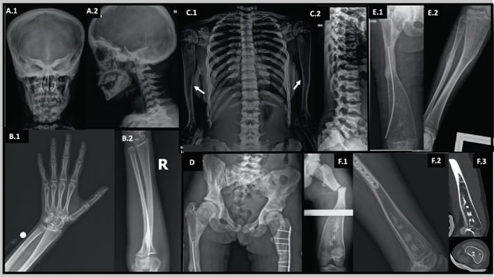 Skull axial skeleton and limb radiographs showing adolescent dysosteosclerosis