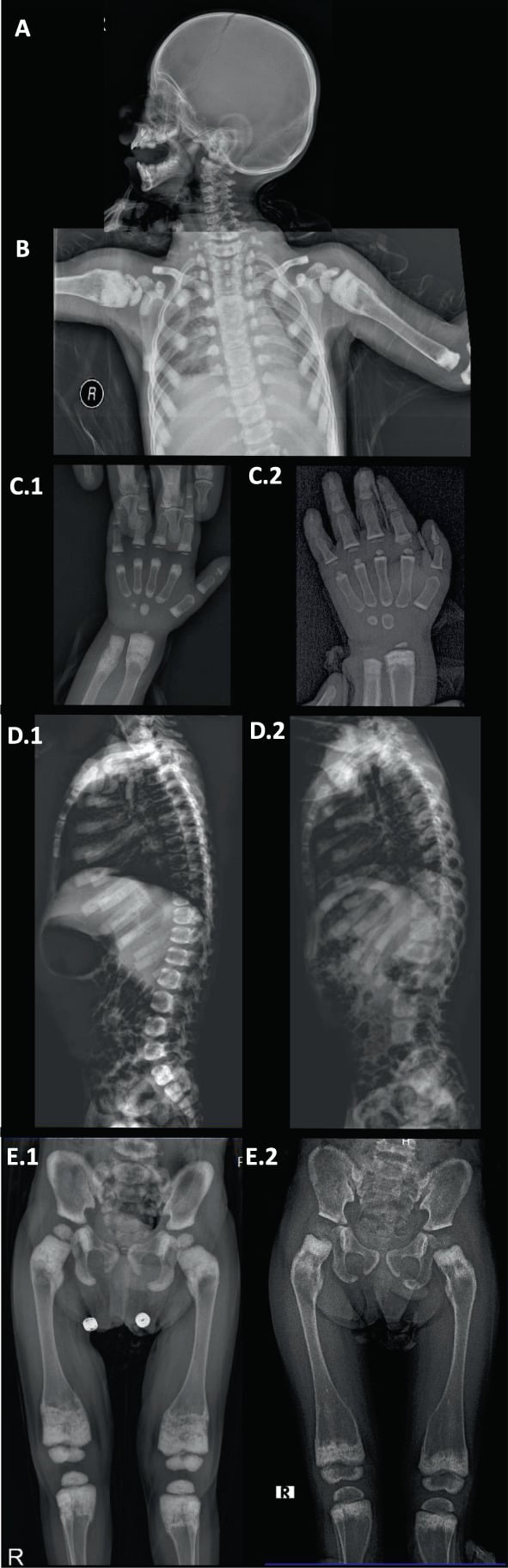 Childhood skeletal survey showing sclerotic widened metaphyses in dysosteosclerosis