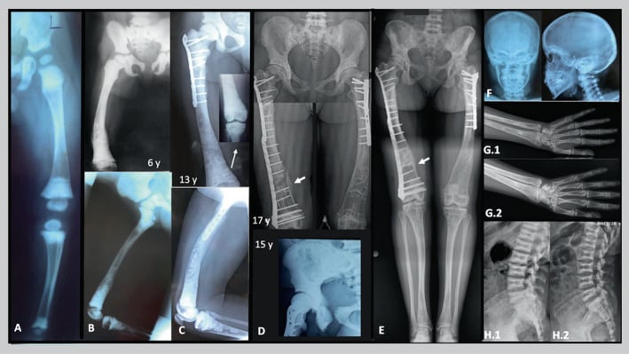 Serial radiographs showing evolving metaphyseal flaring and osteosclerosis in dysosteosclerosis
