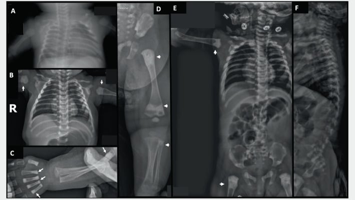 Infant chest limb and hand radiographs showing metaphyseal osteosclerosis in dysosteosclerosis