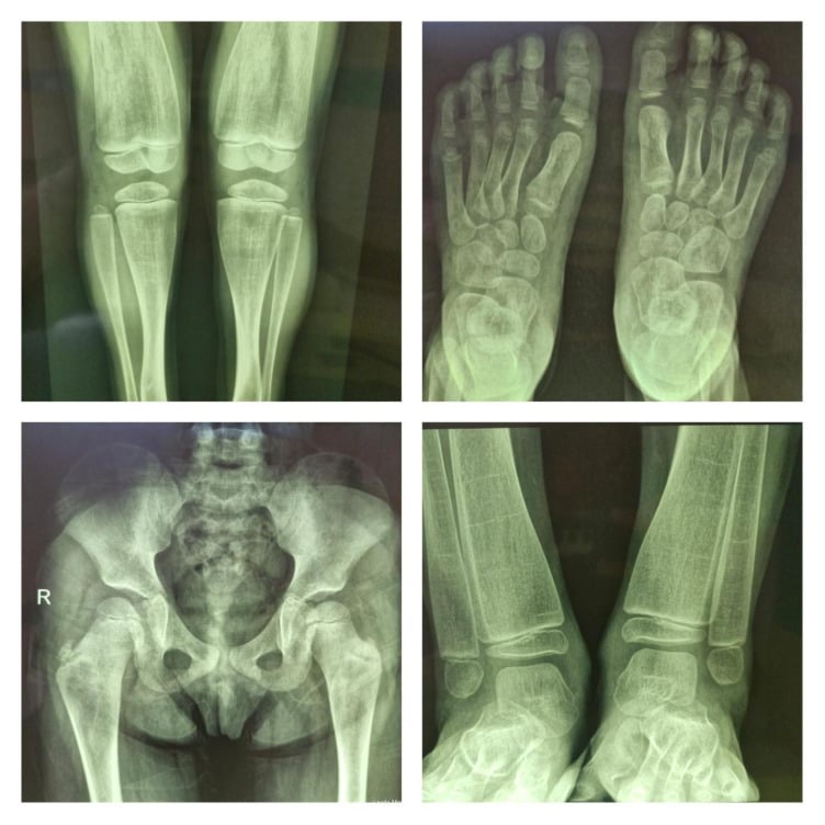 Full-length lower limb radiographs demonstrating bilateral Erlenmeyer flask deformity