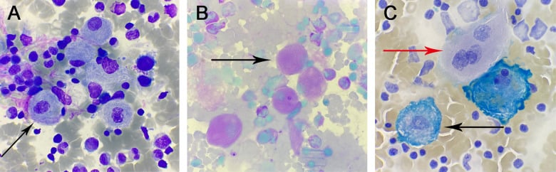 Wright-Giemsa and PAS bone marrow aspirate photomicrograph showing Gaucher cells