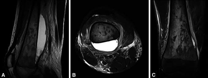 Multiplanar knee MRI showing acute Gaucher bone crisis