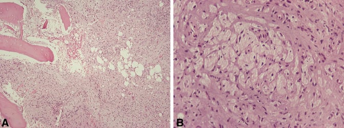 Bone biopsy histology showing Gaucher cells with crumpled-paper cytoplasm