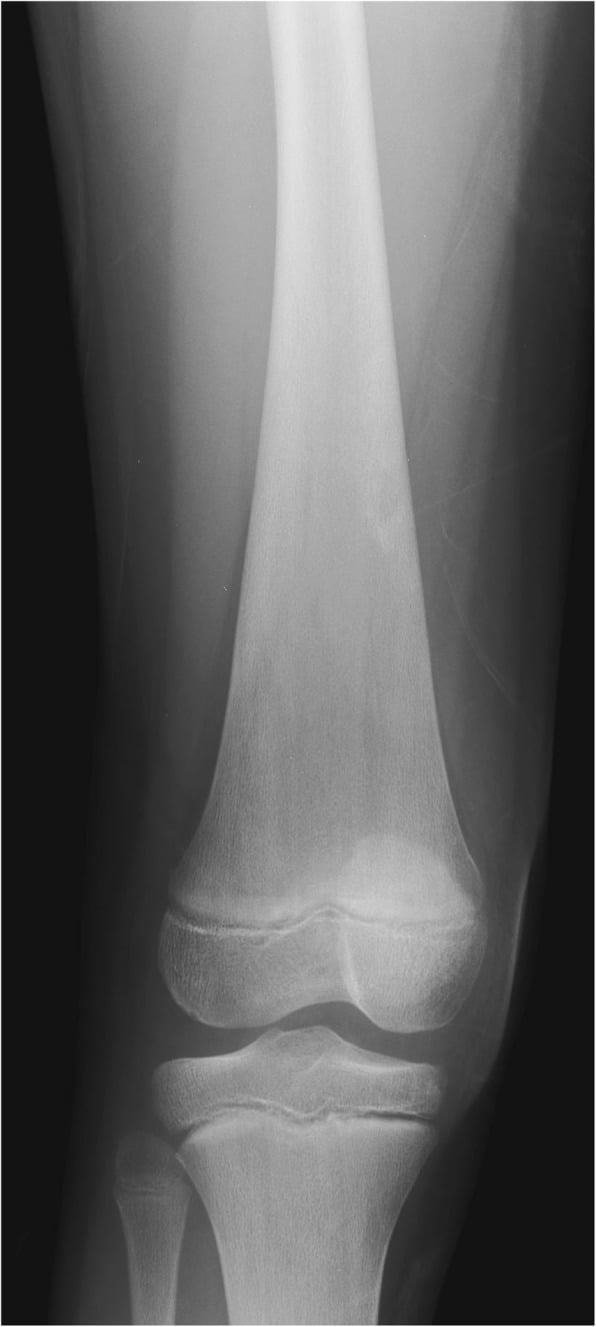 Frontal knee radiograph showing Erlenmeyer flask deformity in Gaucher disease