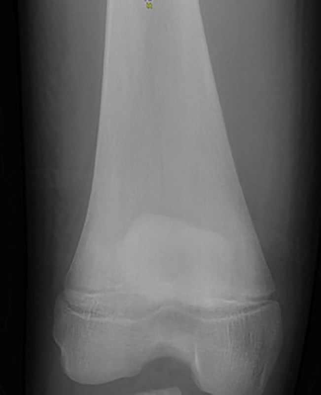 Distal femur radiograph showing Erlenmeyer flask deformity in Gaucher disease