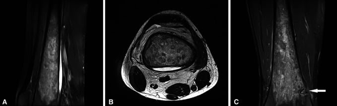 Follow-up knee MRI showing improving Gaucher bone crisis and persistent marrow heterogeneity
