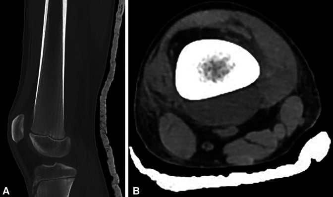 Sagittal and axial CT of distal femur in Gaucher disease