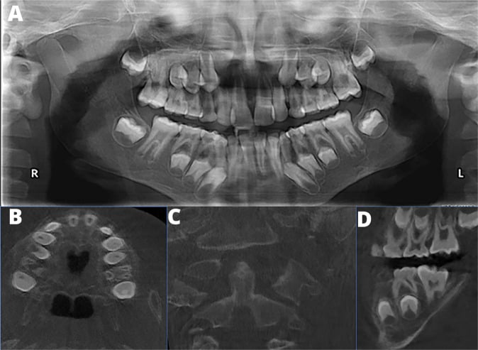 Panoramic and craniofacial radiographs showing Pyle disease