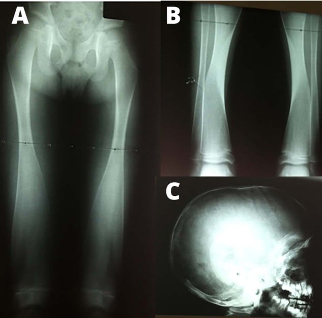 Long-bone and skull radiographs showing Pyle disease with Erlenmeyer flask deformity