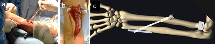 Achilles allograft interosseous membrane reconstruction with operative exposure and forearm tunnel schematic