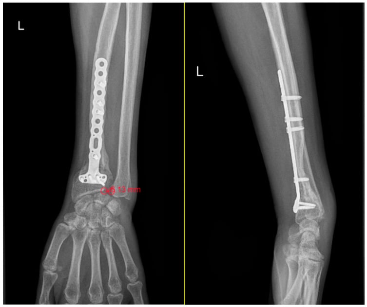 Postoperative wrist radiographs showing measurement of an abnormal distal radioulnar joint gap
