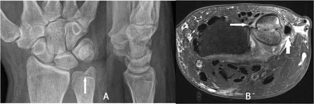 DRUJ subluxation shown by double contour on radiograph and dorsal displacement on axial MRI