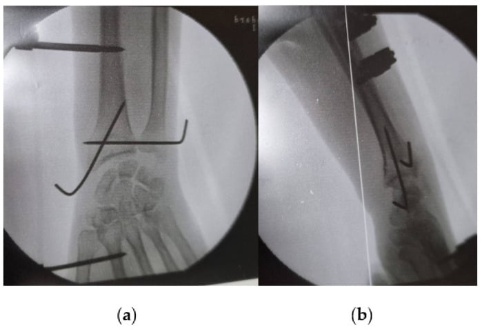 AP and lateral fluoroscopy showing temporary K-wire transfixion of the distal radioulnar joint