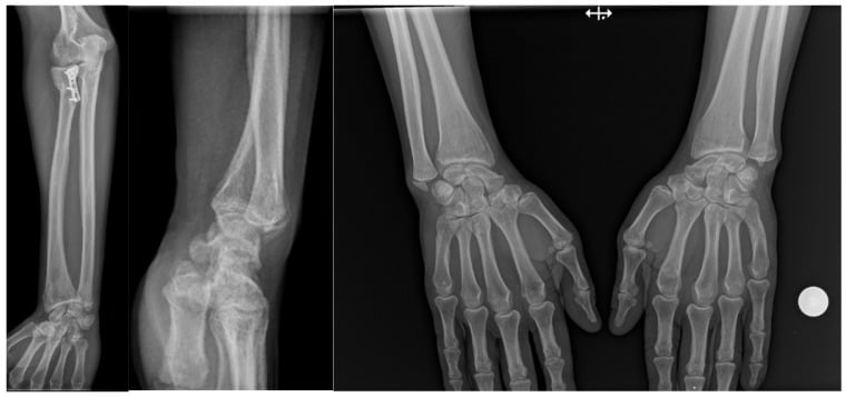 Postoperative Essex-Lopresti injury with radial head fixation, ulnar styloid fracture and dorsal DRUJ displacement
